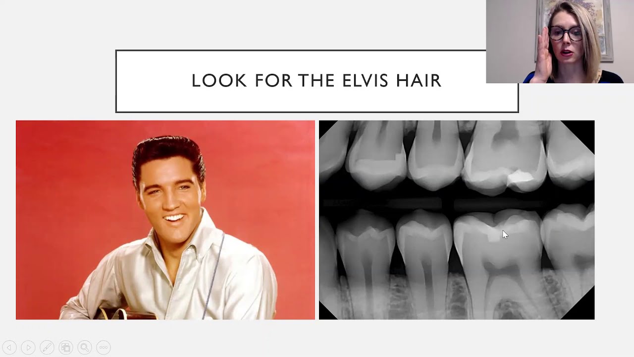 How to Identify Composite Restorations on Radiographs
