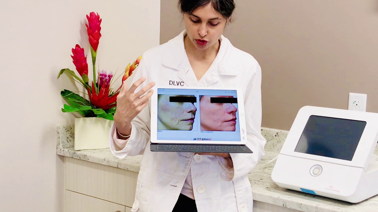 Venus Viva Fractional Radiofrequency Virtual Consultation with Dr. Shalini Gupta