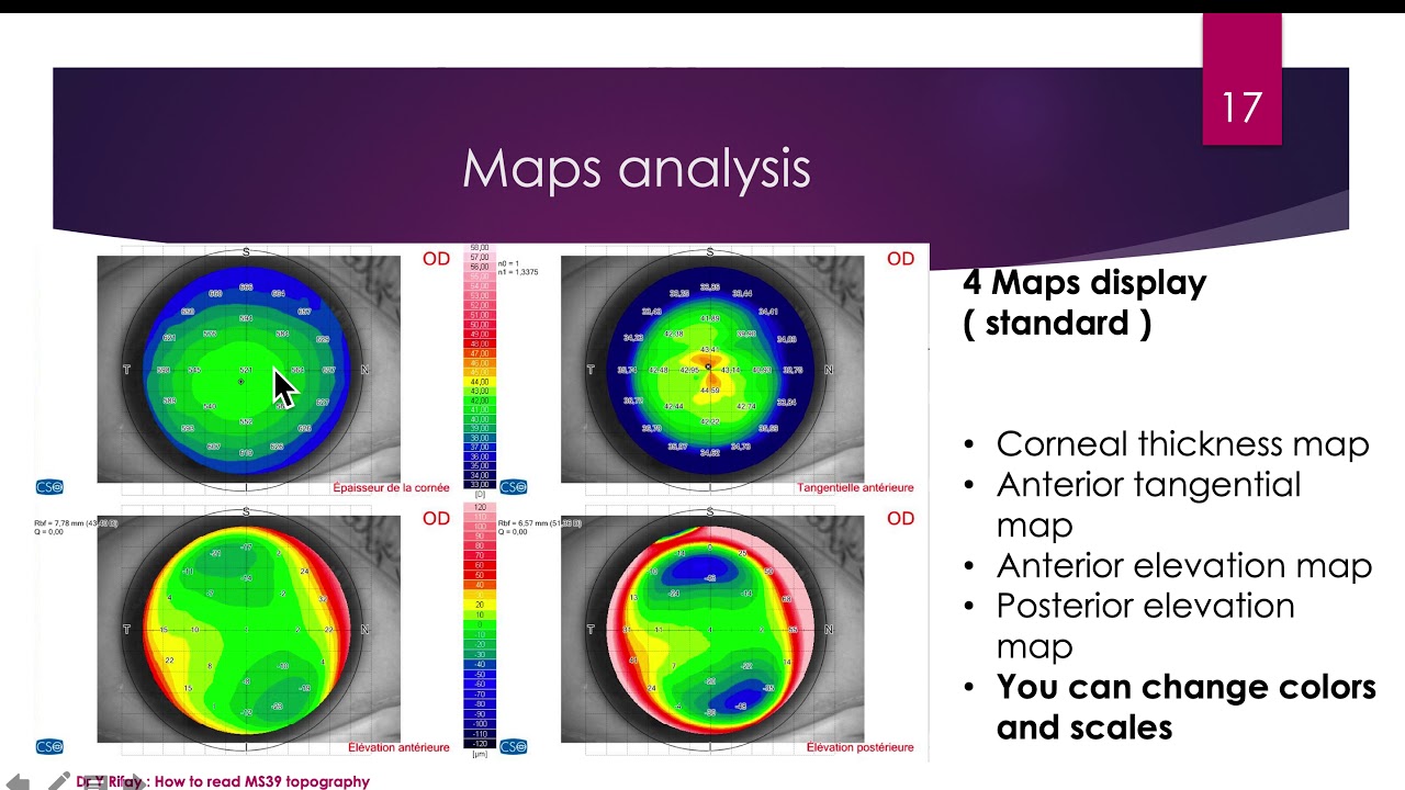 How to read MS39 AS OCT Corneal Topography. Dr.Yasser RIFAY  / ENGLISH ( Phoenix 3.7)