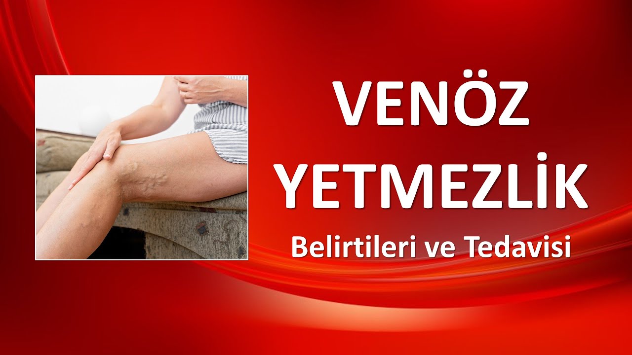 VENÖZ YETMEZLİK Belirtileri ve Tedavisi