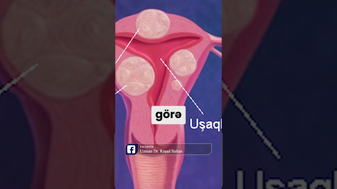 Mioma (uşaqlıq şişi) - Böyüdükcə hansı problemlərə səbəb olur?