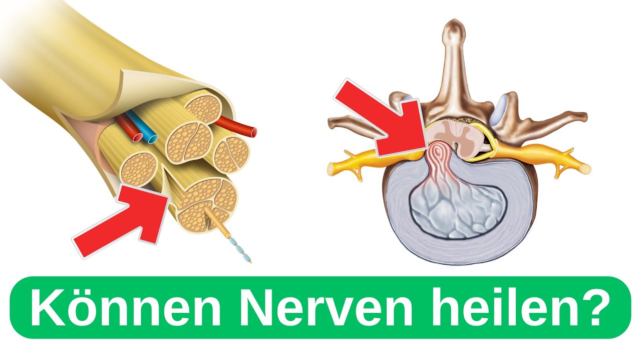 Bandscheibenvorfall (LWS) Lendenwirbelsäule - Können Nerven heilen?
