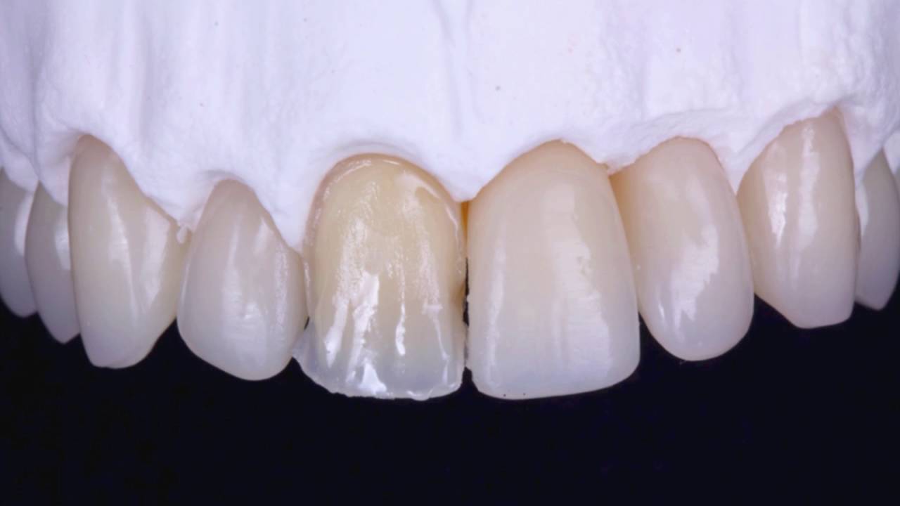 Reconstrucción estética mediante resinas compuestas. El secreto está en la masa