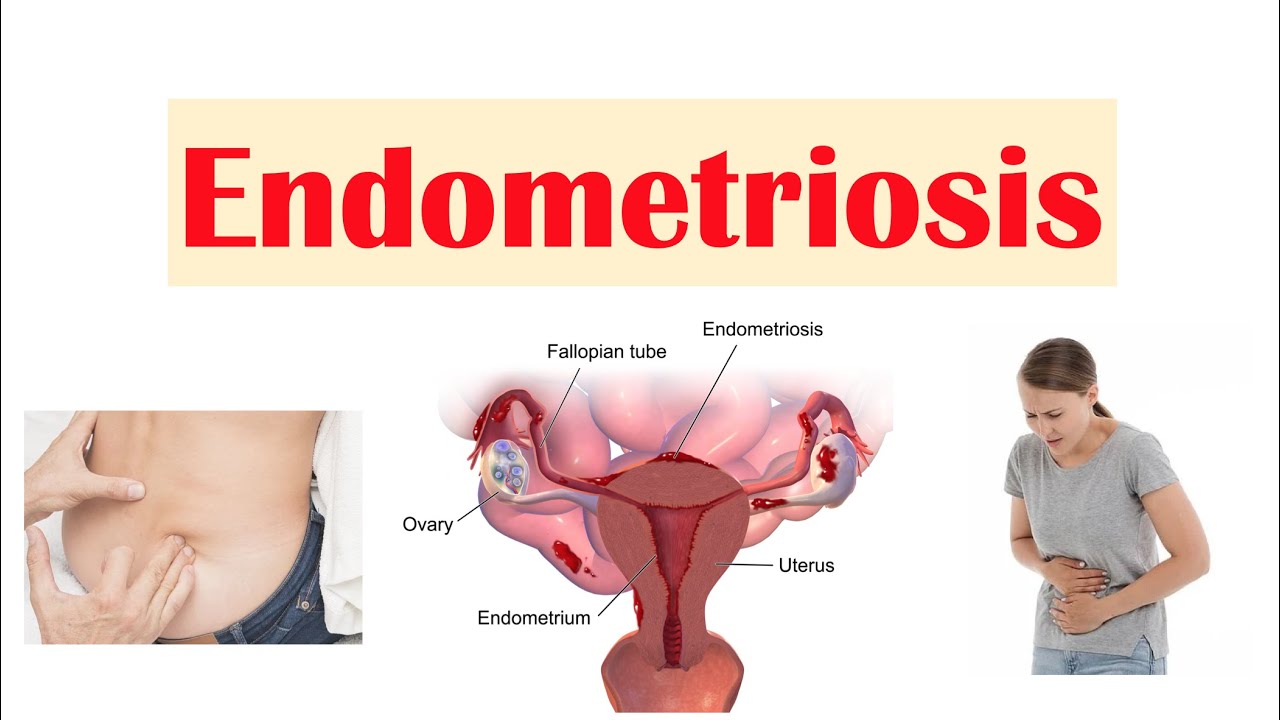 Endometriosis | Causes, Pathophysiology, Symptoms, Diagnosis & Treatment