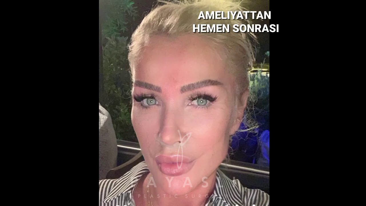Seda Sayan’a Liplift Yaptık📌