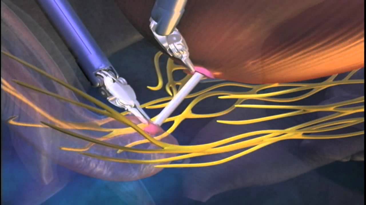 What is a robotic prostatectomy?