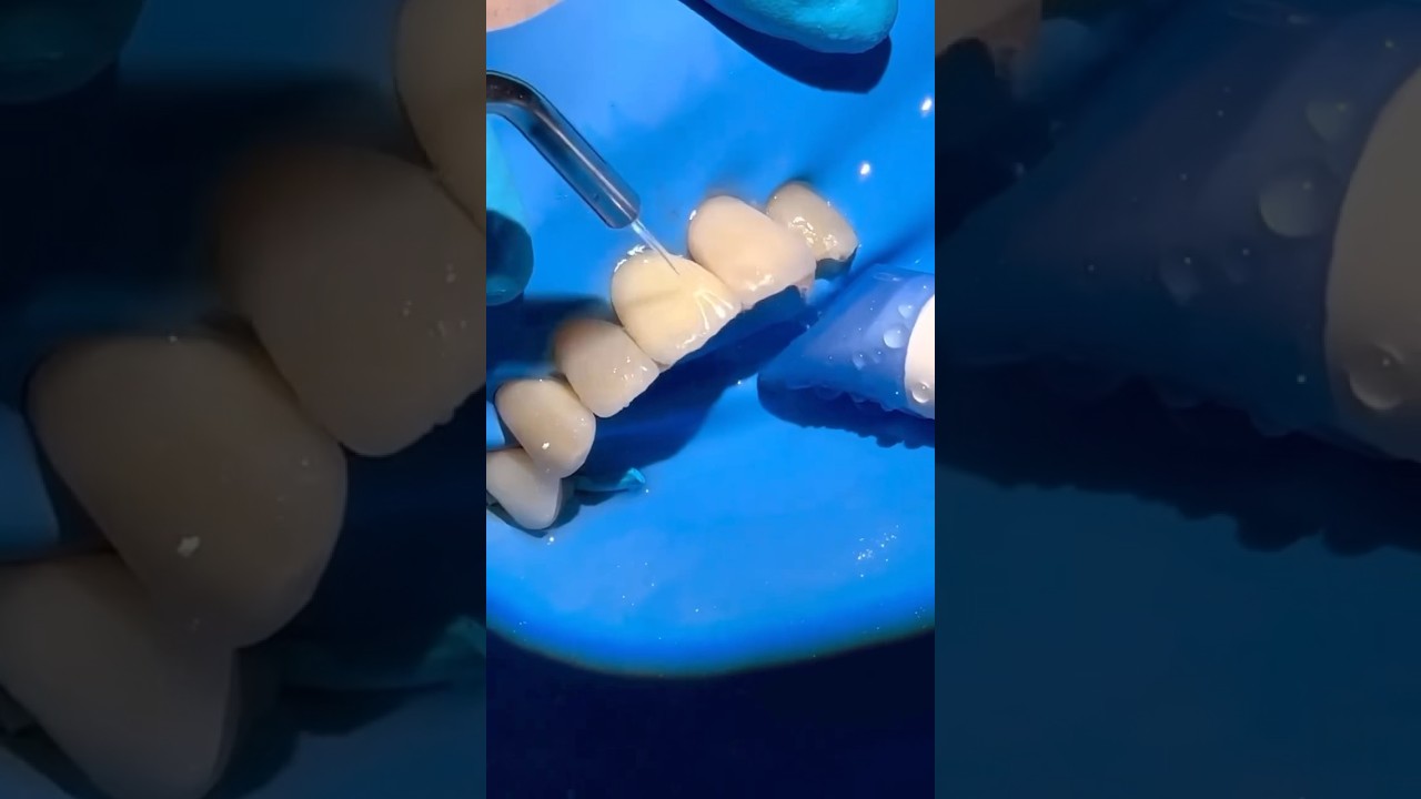 No-Prep Ceramic Veneer Repair: Part II #veneers #veneers #dentist
