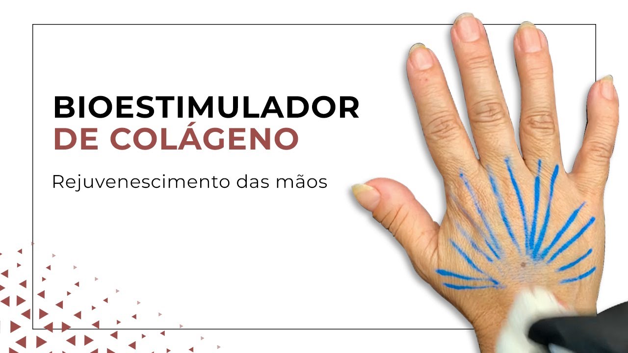 Bioestimuladores de colágeno - Região das mãos
