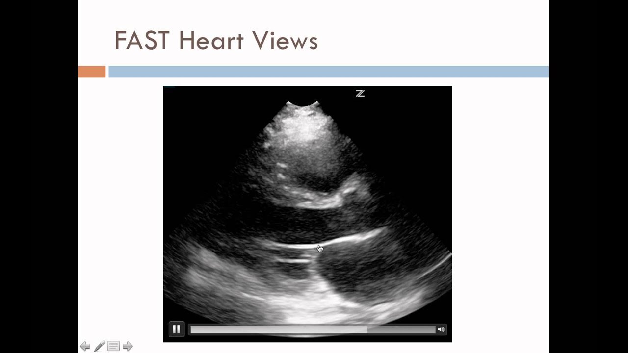 MS4 US Case Traumatic Shock