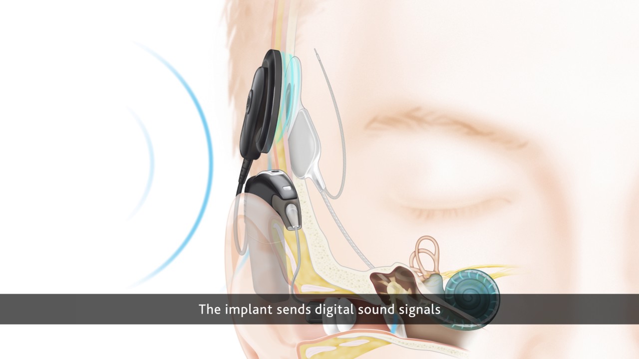 How the Cochlear Nucleus 6 Hybrid System Works