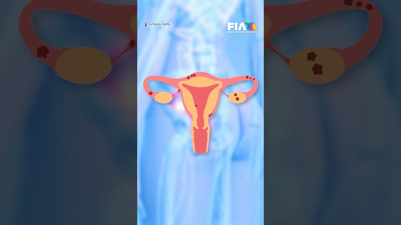 #ConsultaViral | &iexcl;NO ES NORMAL sentir dolor! Endometriosis: enfermedad cr&oacute;nica que no debes ignorar