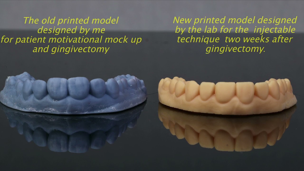 Injectable composite technique.A transitional procedure for full mouth rehabilitation / د.حسين نعمة