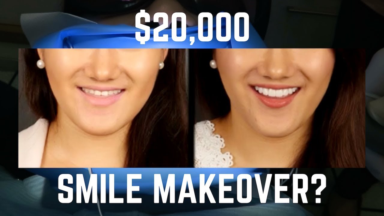 MY SMILE TRANSFORMATION (Porcelain Veneers)