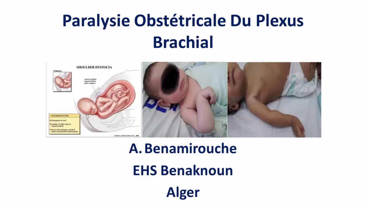 Paralysie obstétricale du plexus brachial