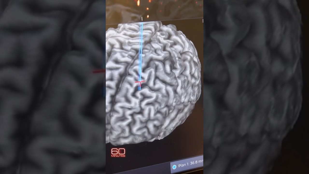 A cutting-edge approach to brain surgery with no cutting #shorts