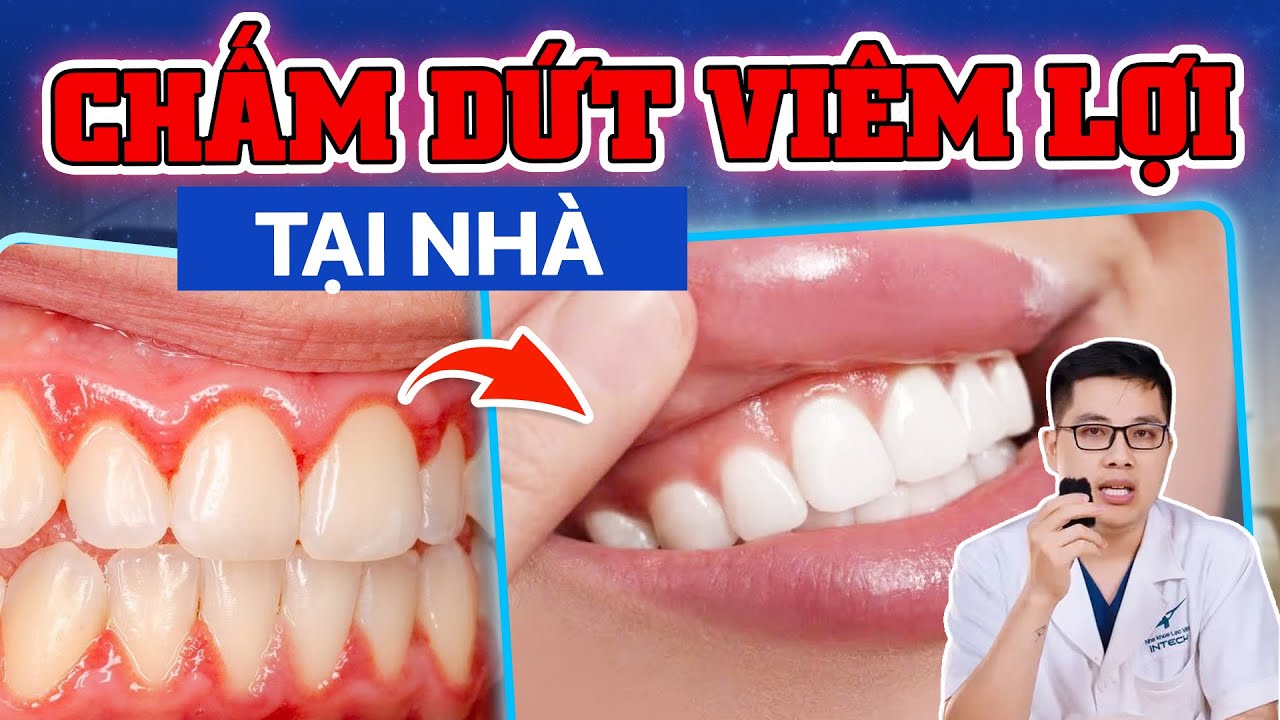 Chữa Viêm Lợi Tại Nhà: Thử Ngay 3 Cách Chữa Viêm Lợi Tại Nhà Giá 