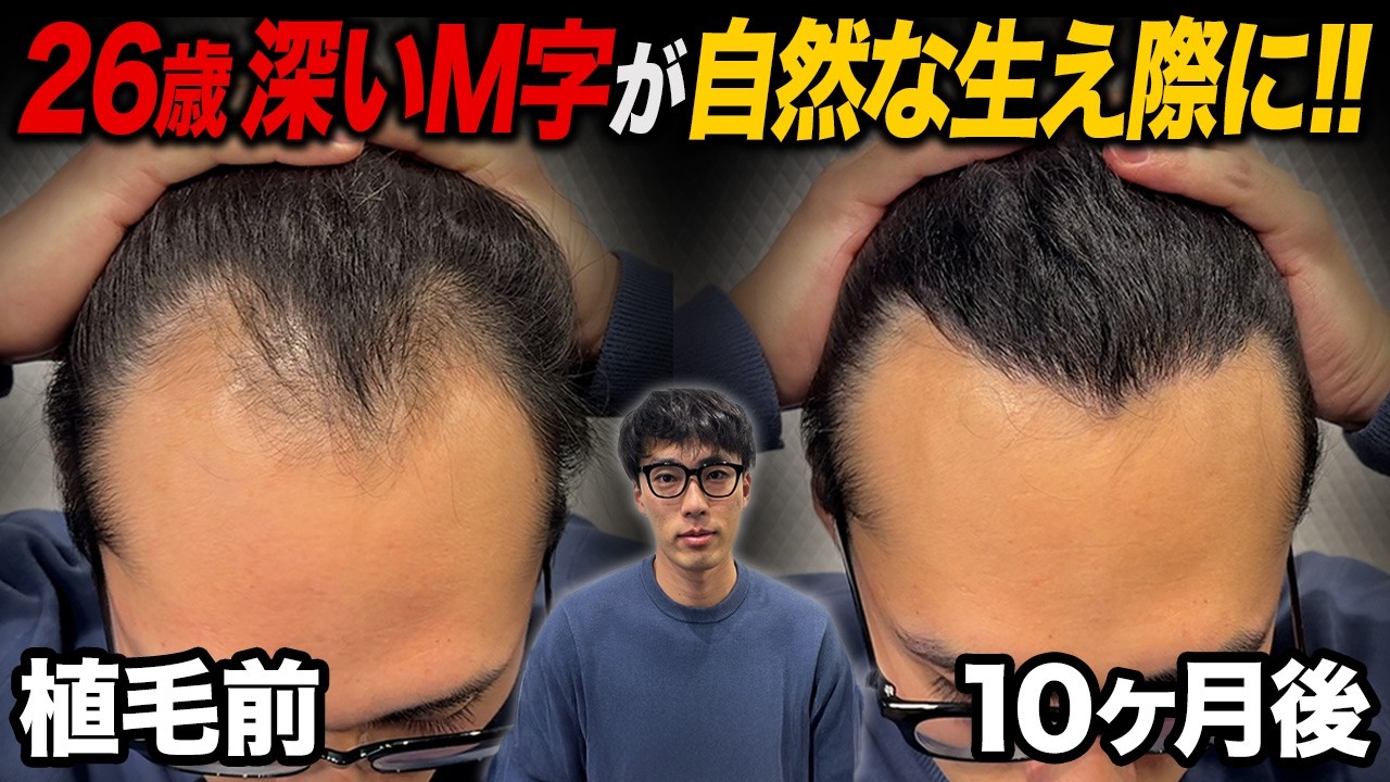 【深いM字】植毛10ヶ月で生え際のラインが出た!!26歳のリアルな結果