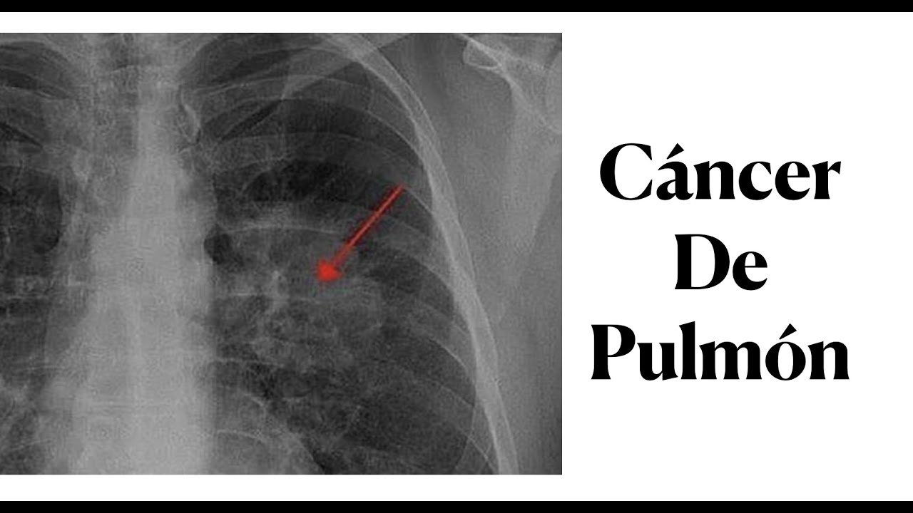 Cáncer de pulmón: Síntomas y Diagnóstico - Factores de riesgo