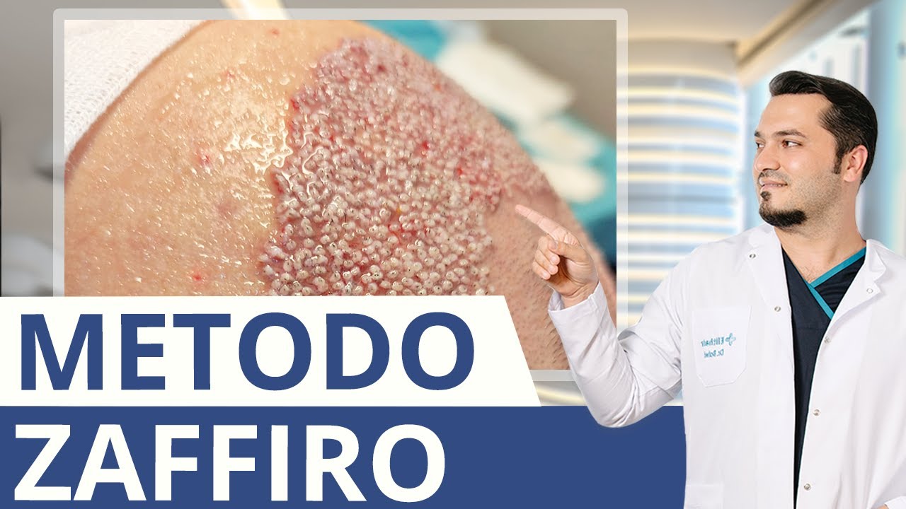 Cos&rsquo;&egrave; il trapianto di capelli Zaffiro? Il dottor Balwi spiega!