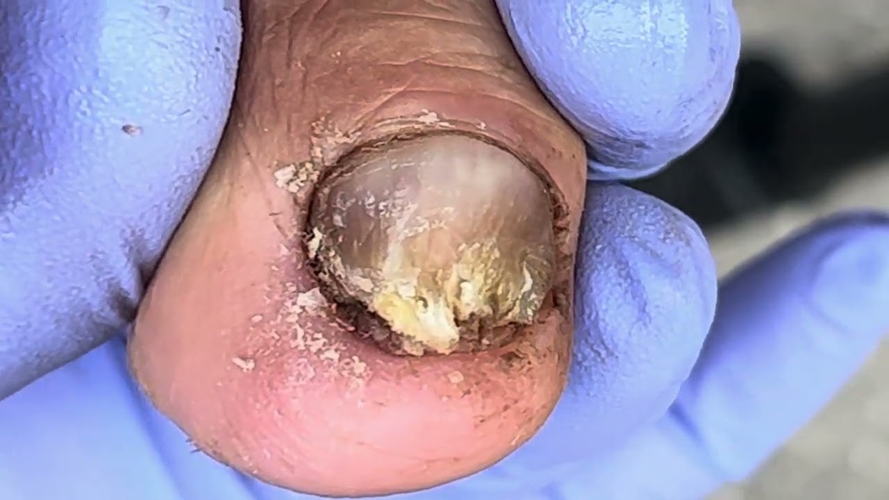 Cut off the onychomycosis crisply, very thick【Xue Yidao】