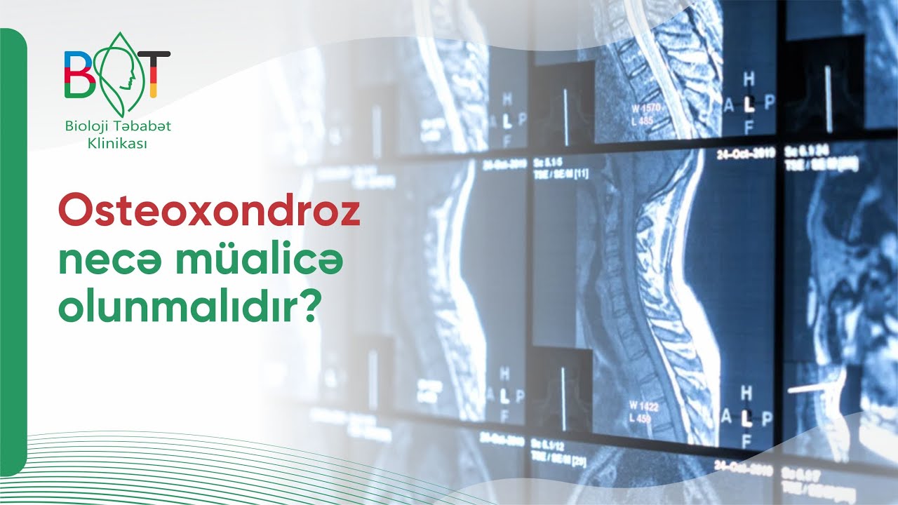 Osteoxondrozun nevroloji fəsadları #osteoxondroz #nevroloq