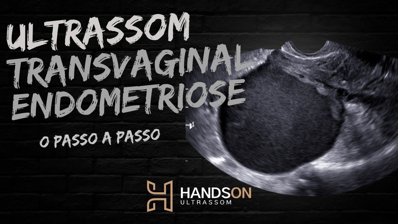 Ultrassonografia Transvaginal com Preparo Intestinal para endometriose / HandsOn Ultrassom