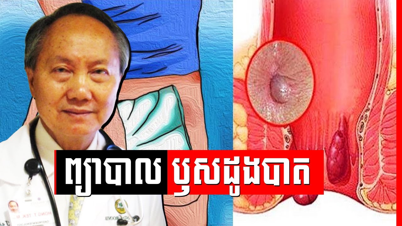 ជំងឺ​ឫស​ដូងបាត​អាច​ព្យាបាល​បាន​តាម​វិធីសាស្រ្ត​សាមញ្ញៗ , Hemorrhoids