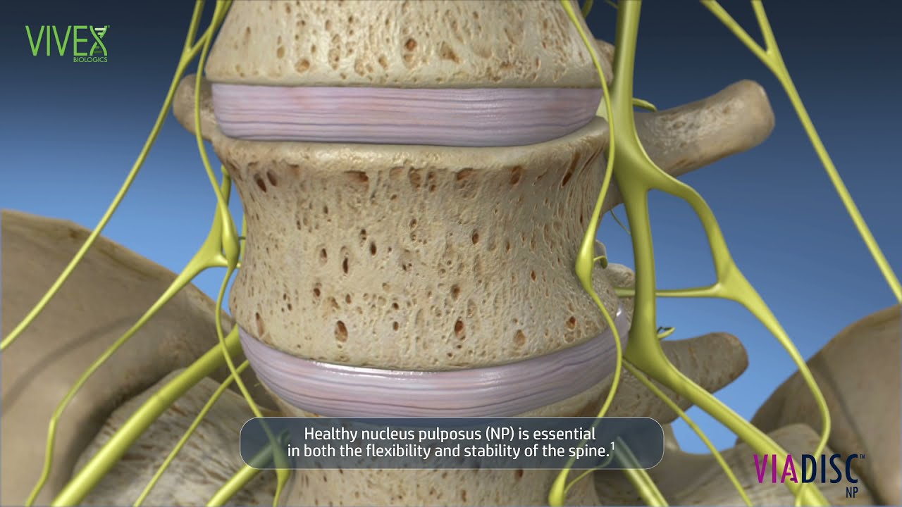 VIA Disc - Regenerative Therapy for Back Pain