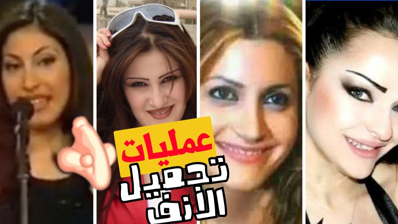 الصقر : مشاهير قبل و بعد عملية تجميل الانف , نتائج صادمة و كوارث