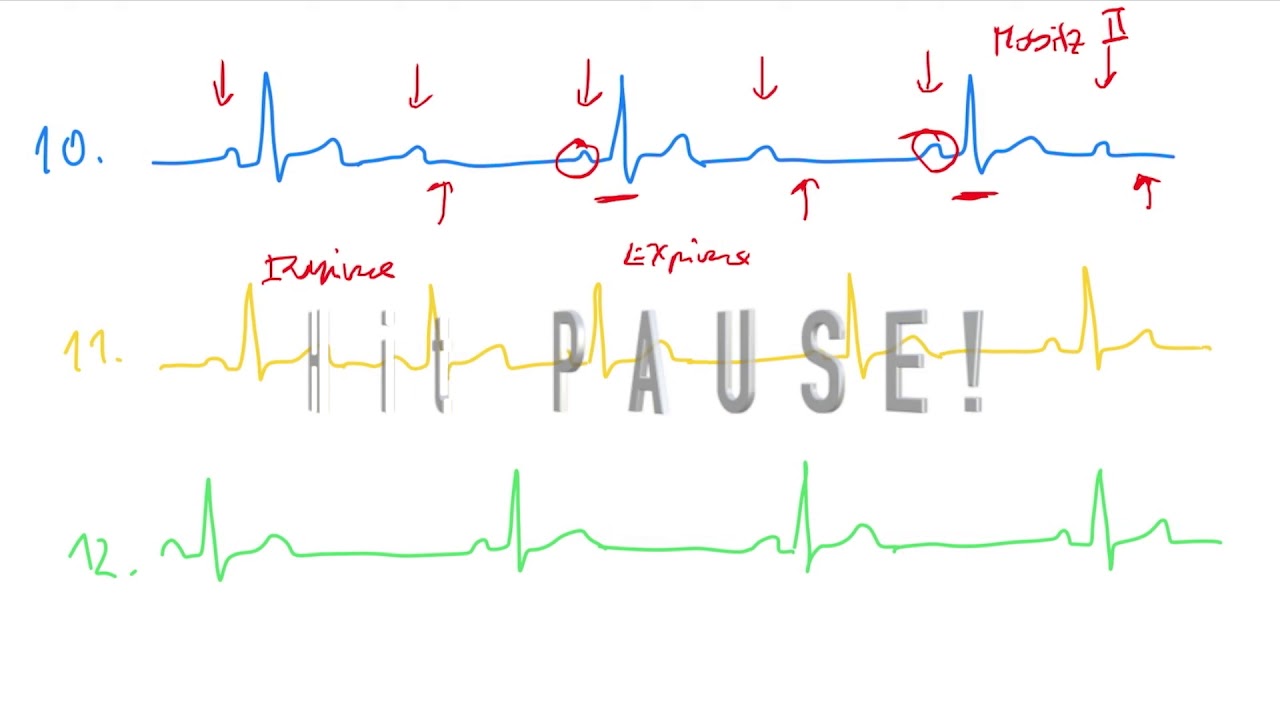 EKG 6 by Coiled CZECH (síňová a komorová tachykardie, flutter síní a komor, fibrilace síní a komor)