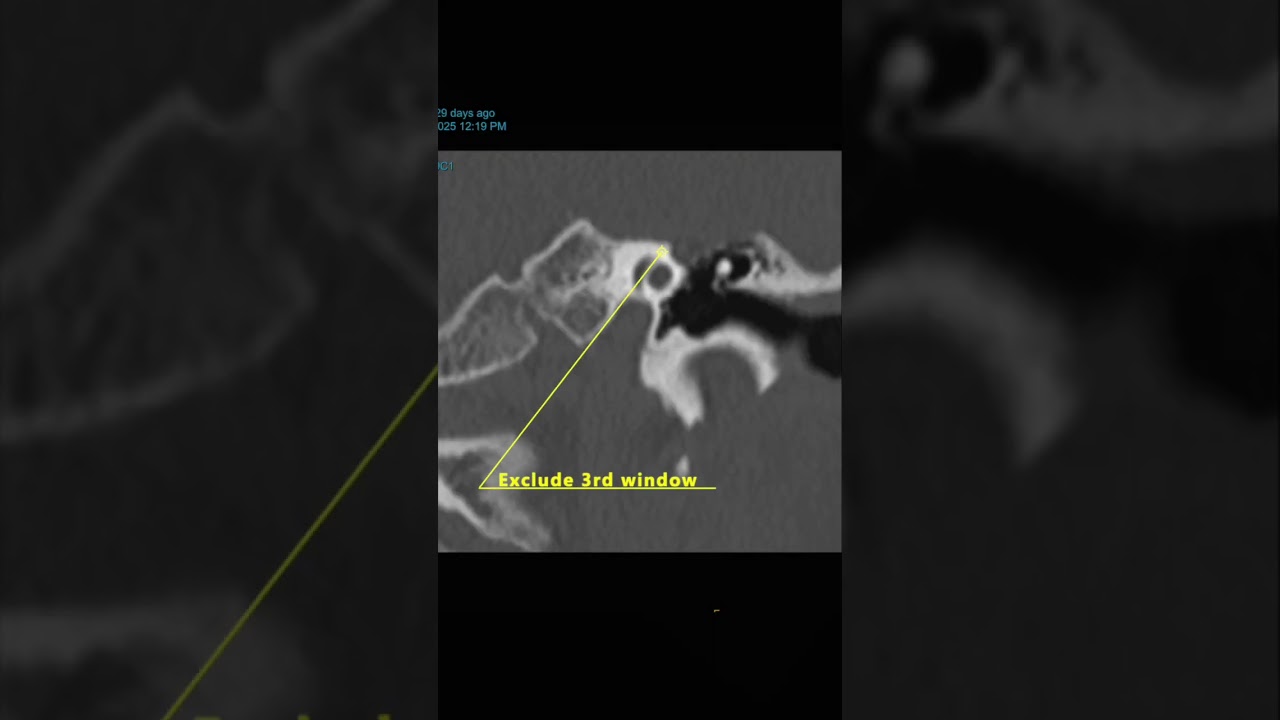 Preop CT scan for Otosclerosis Stapedectomy _Dr Nirmal Patel #ears#shorts #otosclerosis