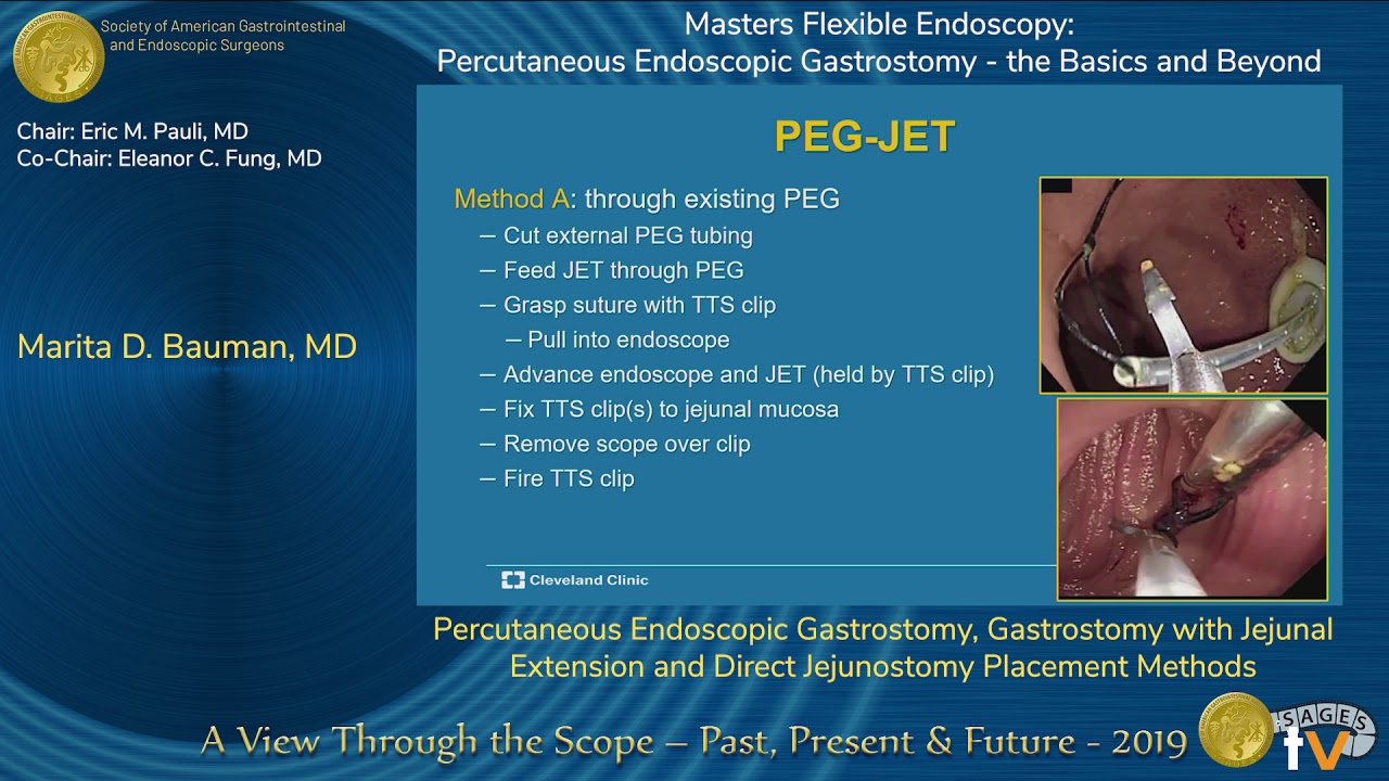 Percutaneous Endoscopic Gastrostomy, Gastrostomy with Jejunal Extension...