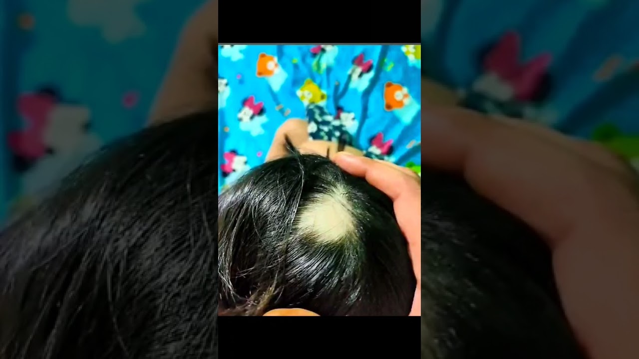 Alopecia Areata / Dr. Sanchika Gupta 👩&zwj;⚕️