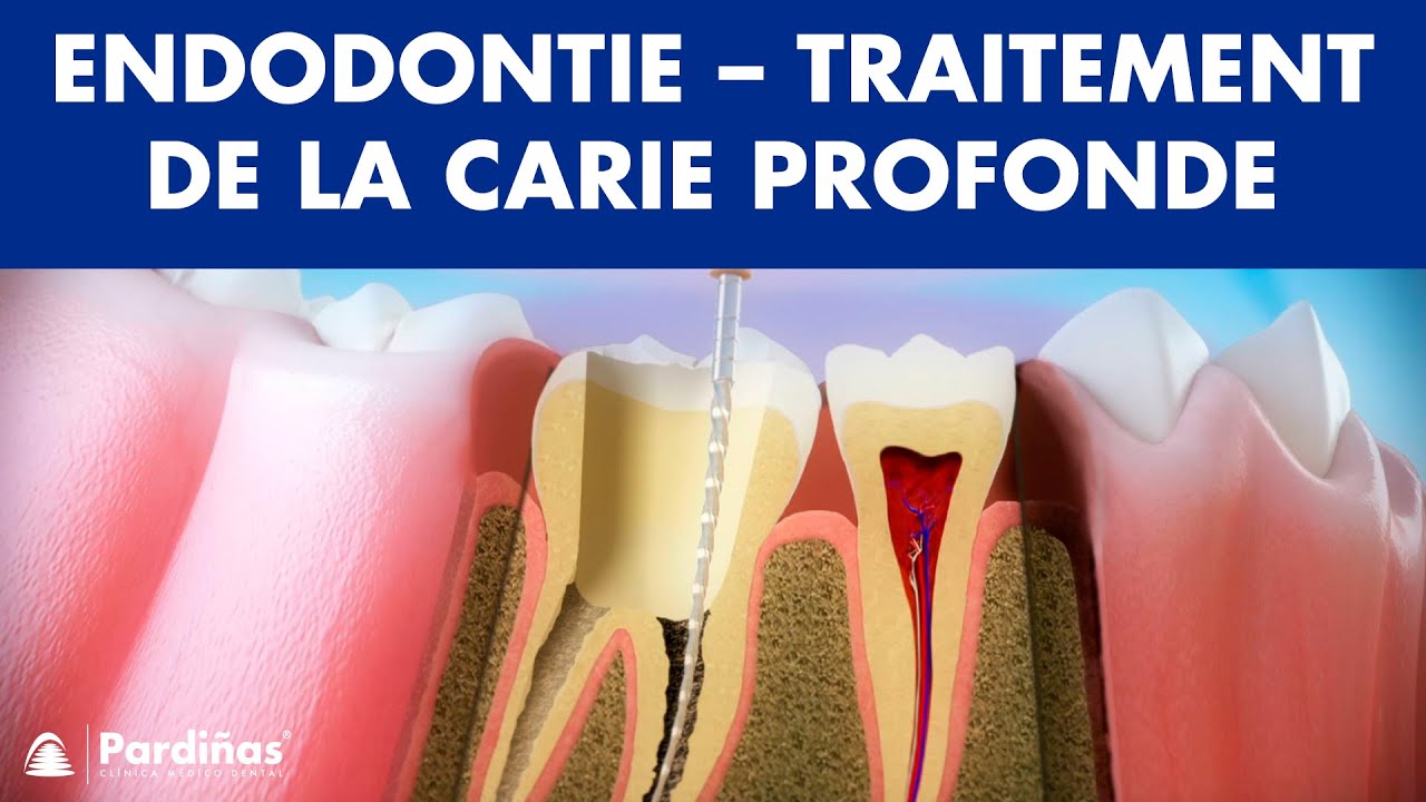 Endodontie - Traitement de la carie profonde ©