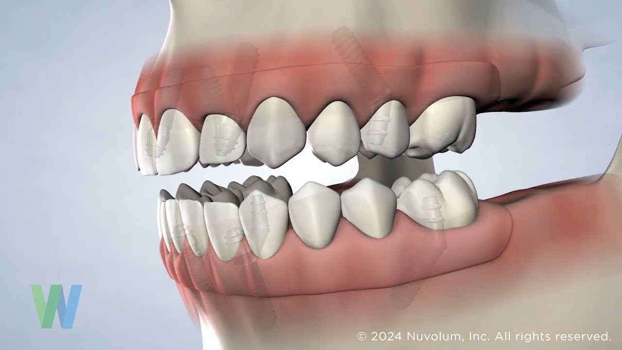 Teeth Today (Full-Arch Restoration) at Westwood Oral Surgery & Dental Implants