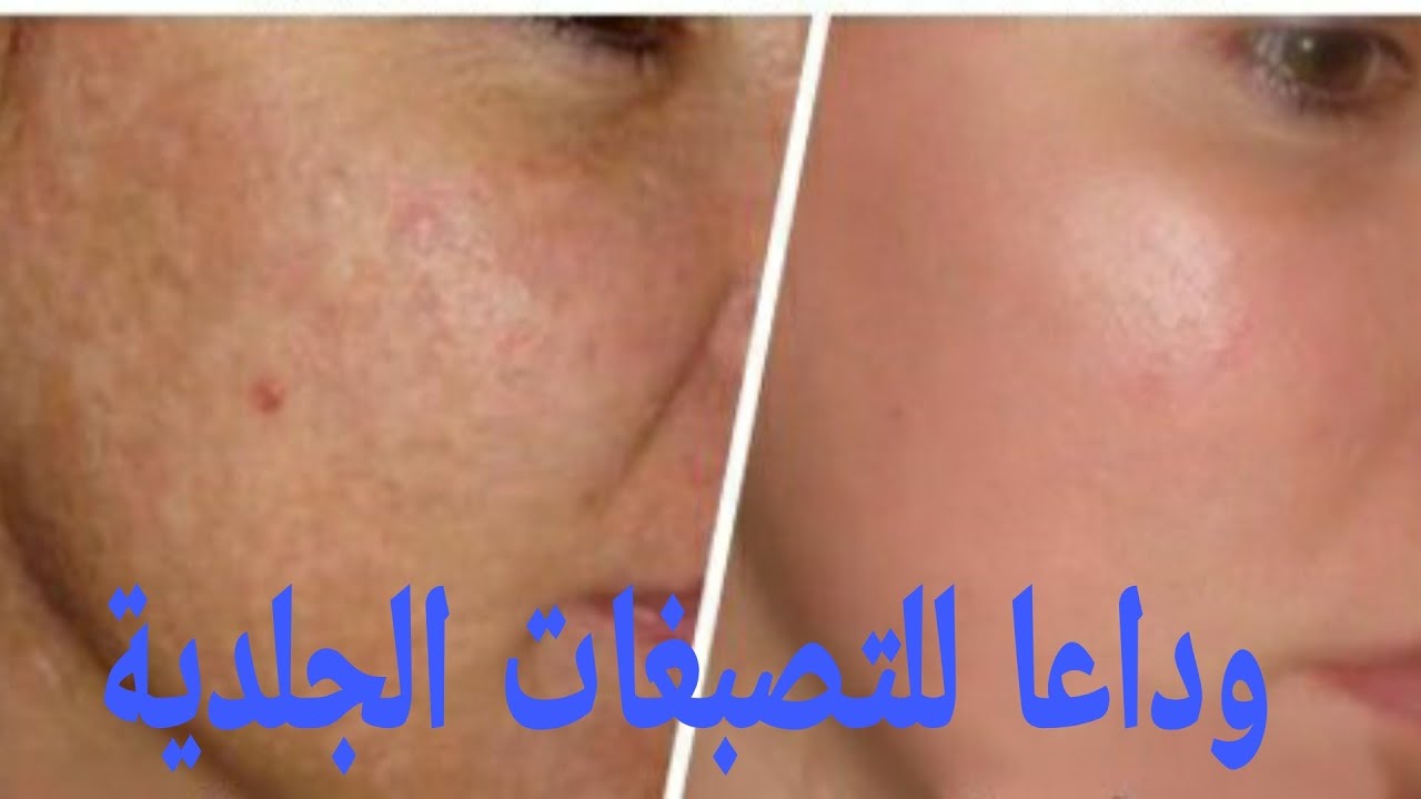 Neosoins Gel HQ أول كريم معالج للتصبغات الجلدية بنجاح