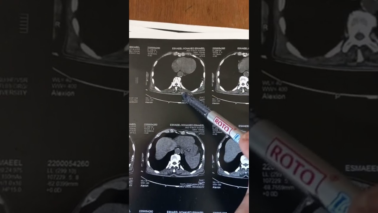 Nonenhanced CT Pelviabdominal - Part 1
