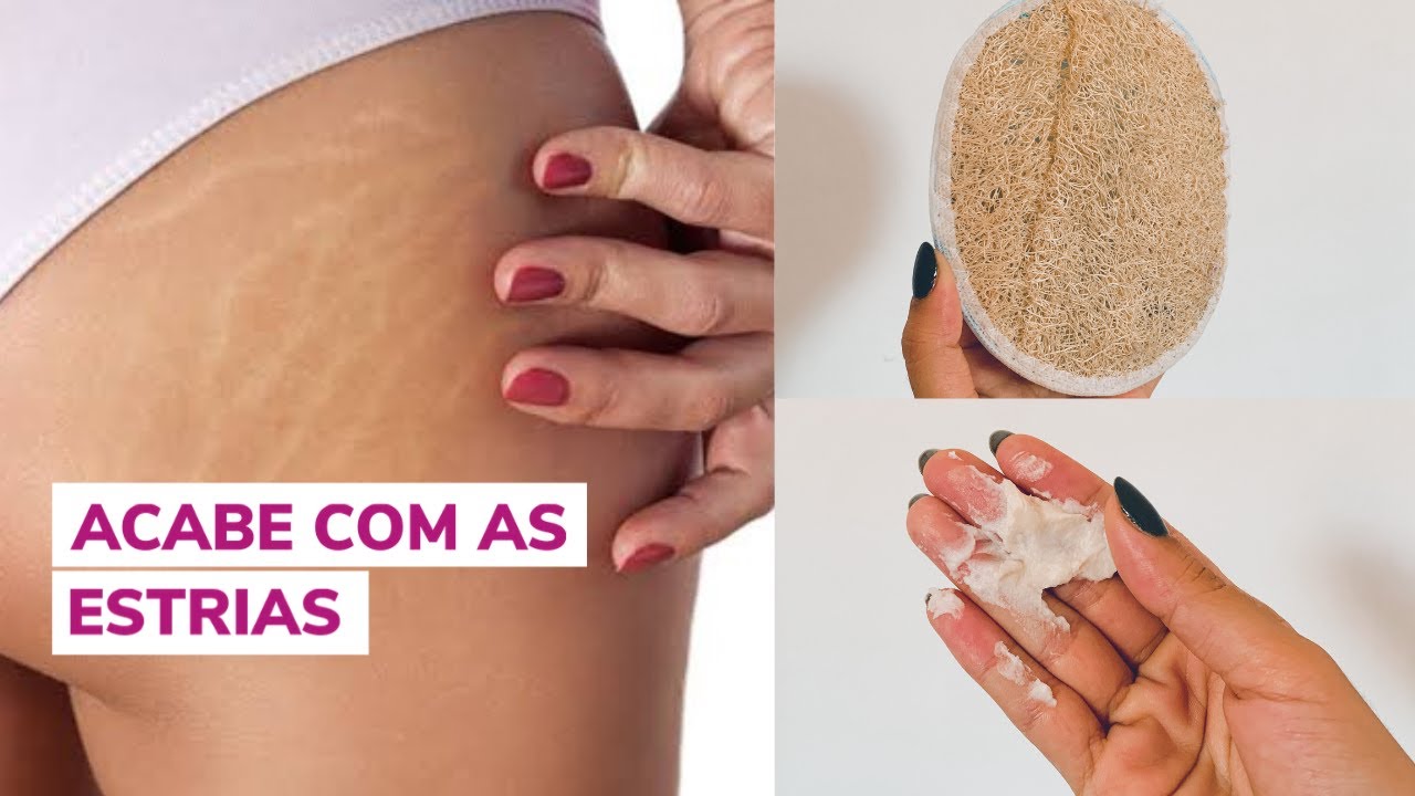 COMO CUIDO DAS MINHAS ESTRIAS BRANCAS EM CASA | DICAS PARA ESTRIAS BRANCAS E VERMELHAS