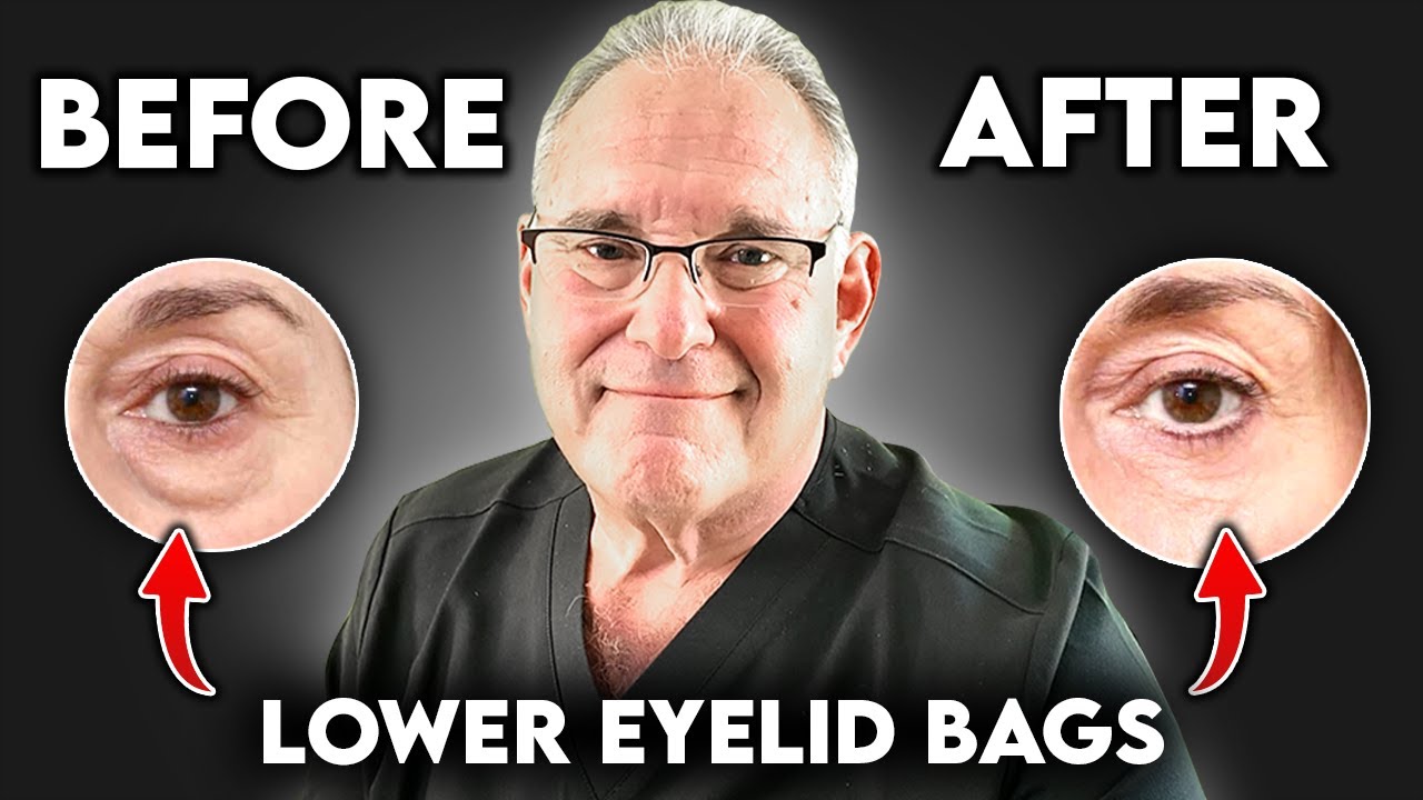 Lower Eyelid Bags Surgery: Full Overview - Costs, Recovery & Results