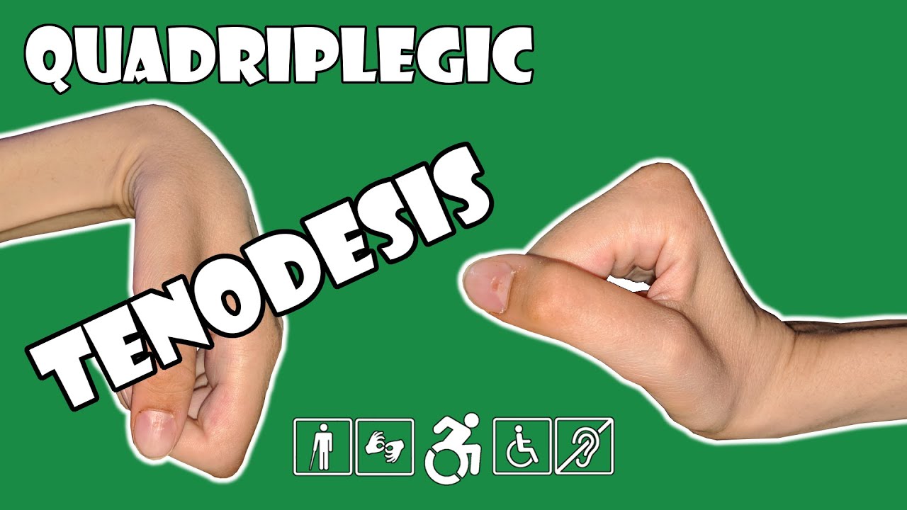 Tenodesis - Explained | Quadriplegic (C5,C6,C7)