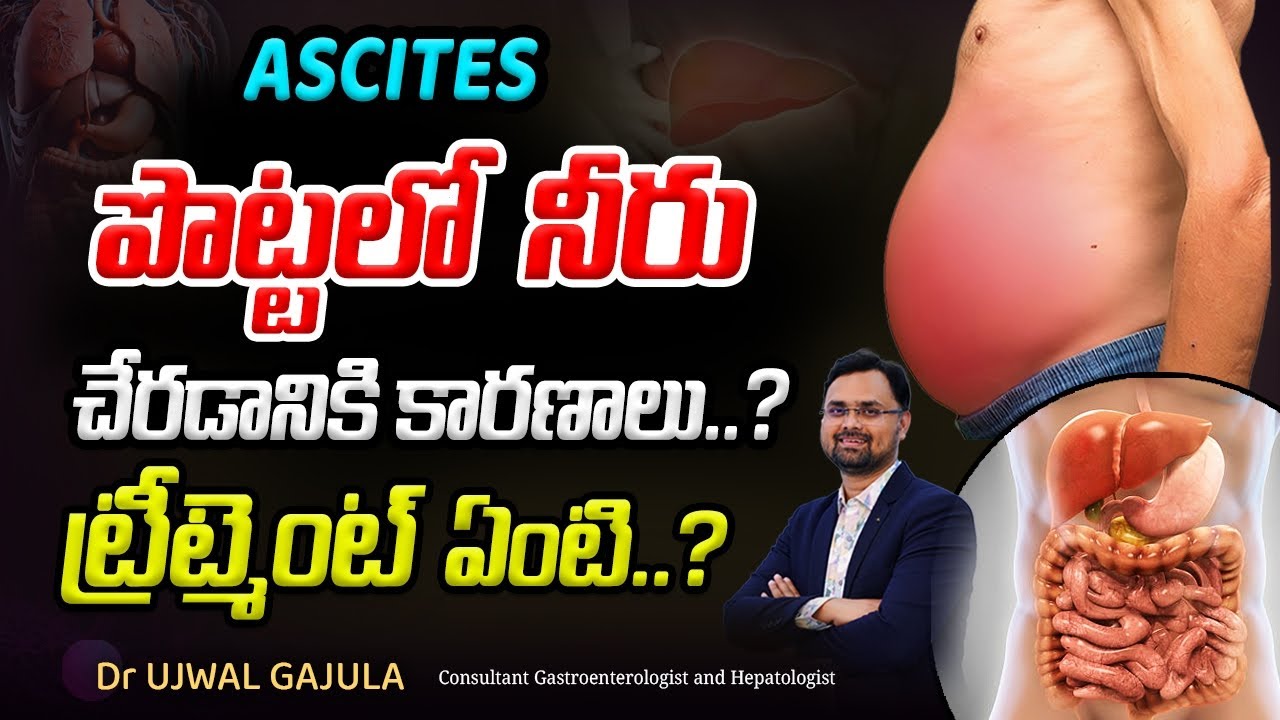 పొట్టలో నీరు చేరడం వల్ల ప్రమాదం ఉందా ? | Ascites | Dr Ujwal Gajula