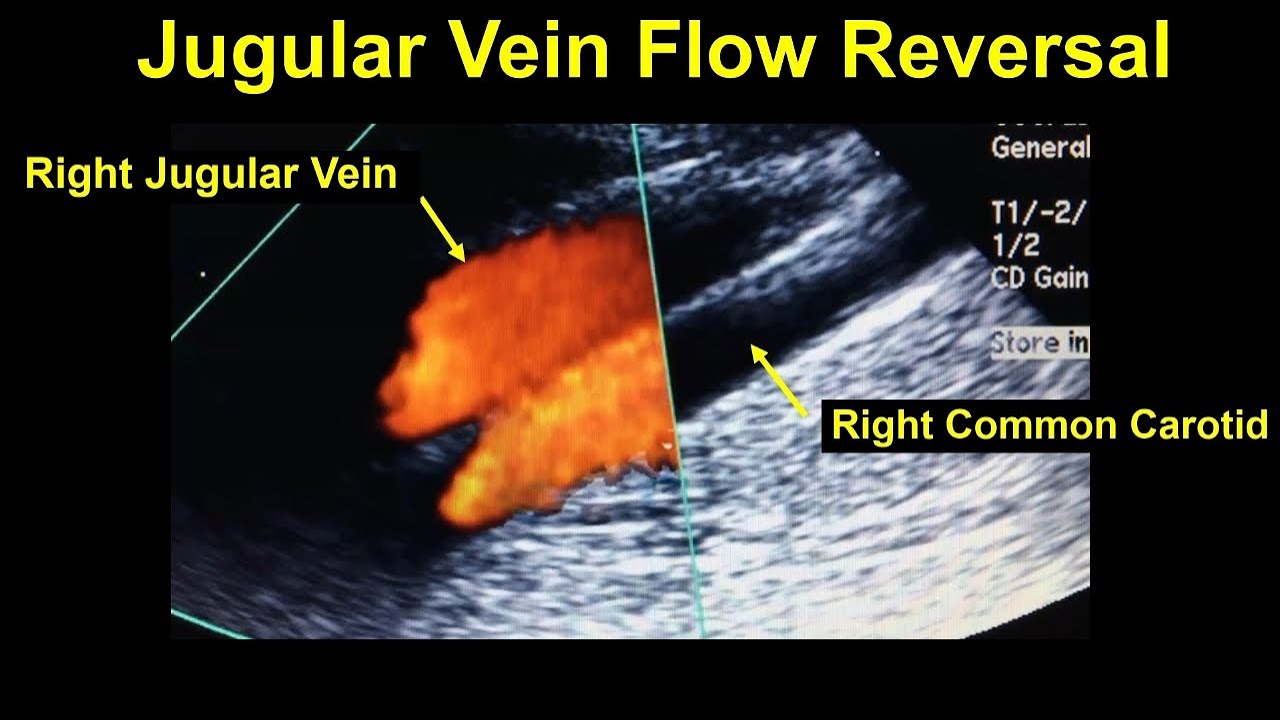 The Mysterious Case of Jugular Vein Flow Reversal