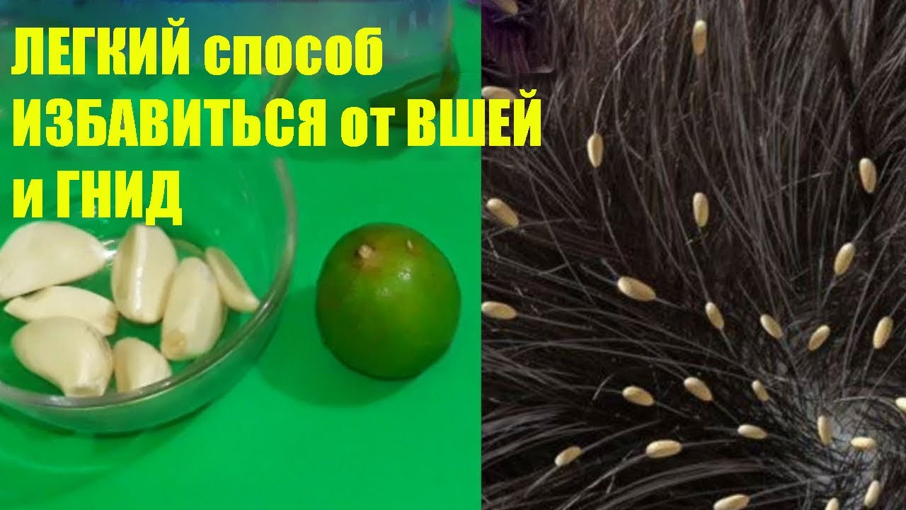 Как Быстро Избавиться от Вшей в Домашних Условиях