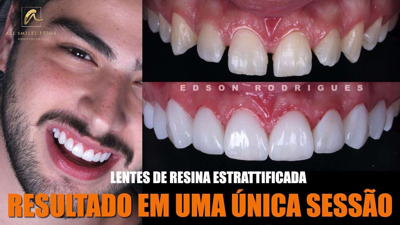 FECHANDO DIASTEMAS EM UMA SESSÃO!