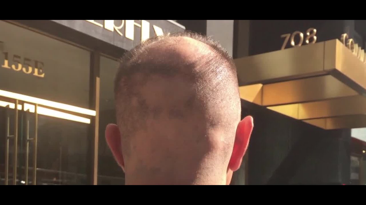 Las Vegas neurosurgeon speaks on the autoimmune disease, alopecia