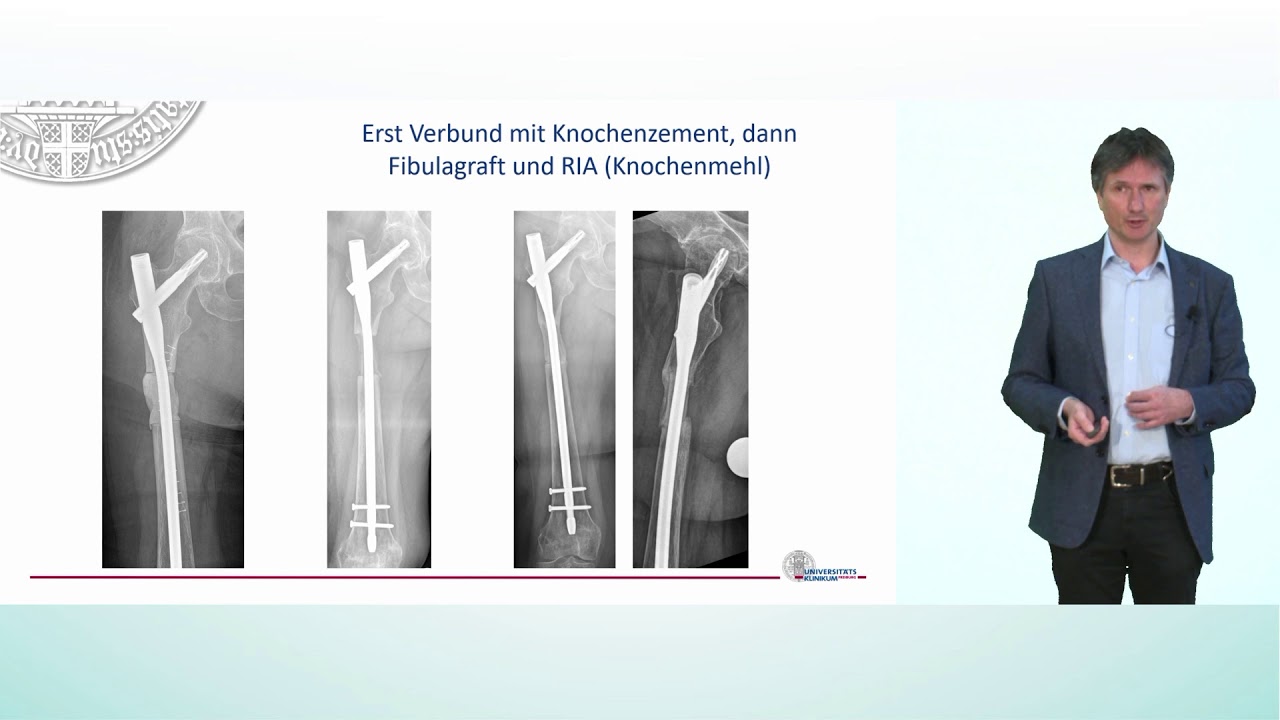 Chirurgische Optionen bei Knochenmetastasen im Bereich der Extremitäten | Prof. Dr. Hagen Schmal