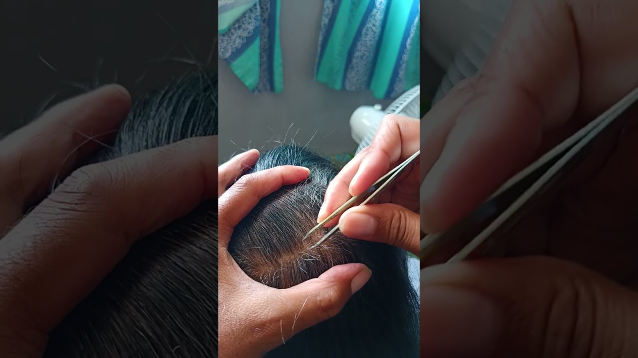 Most satisfying white hair removal 1.38 part 1 #relaxing #satisfying #stressremoval 