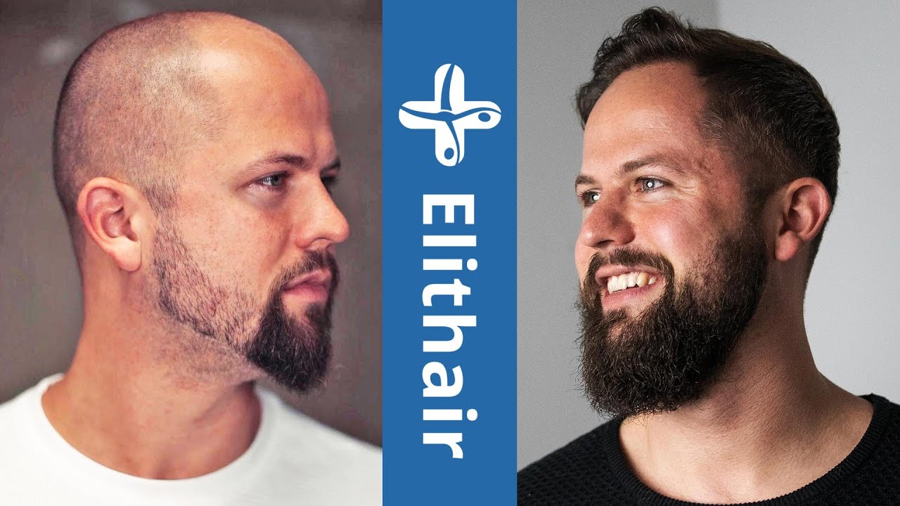 Elithair | Le N°1 pour votre greffe capillaire