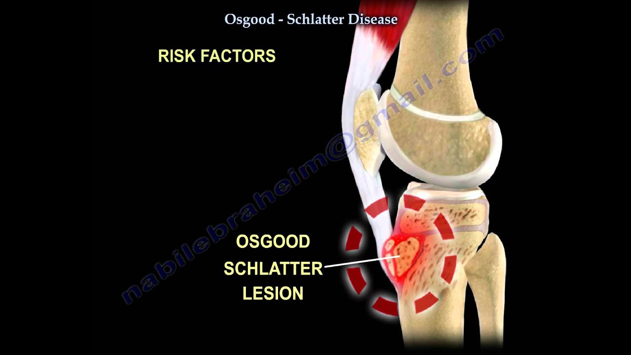 Osgood Schlatter Disease - Everything You Need To Know - Dr. Nabil Ebraheim