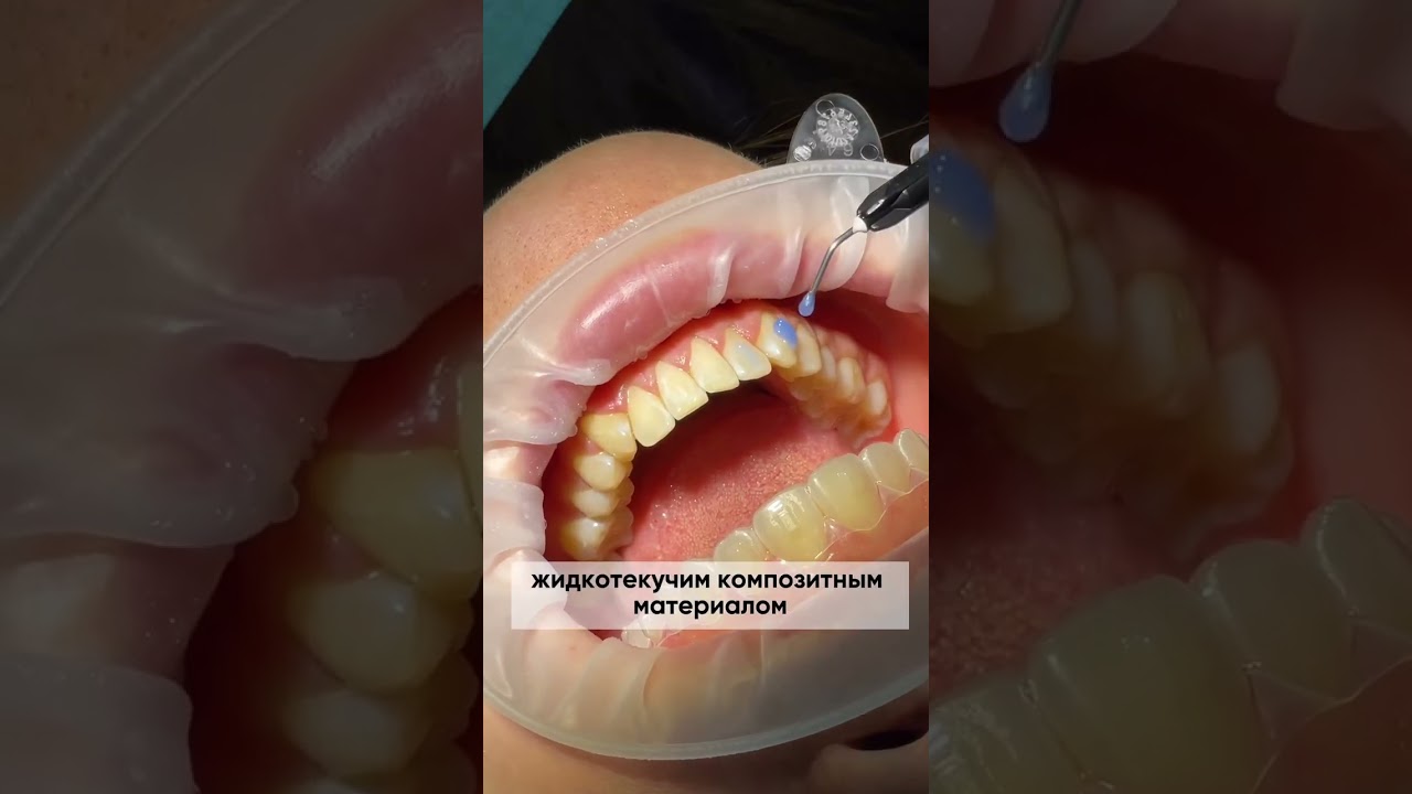 элайнеры Invisalign